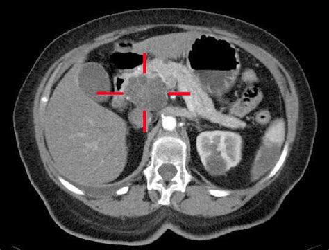 Pancreatic Cancer - Clinical Features - Management - TeachMeSurgery