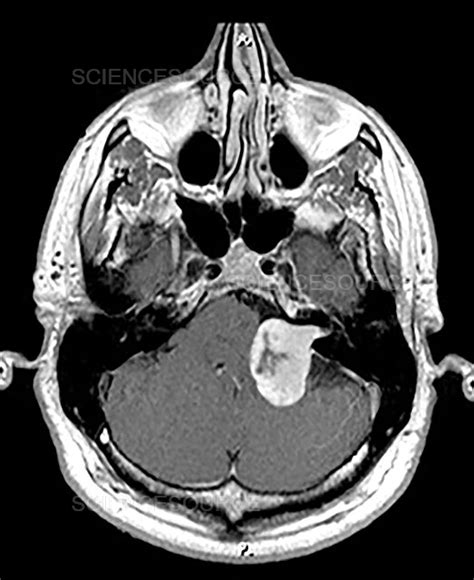 Vestibular Schwannoma, MRI (Post-Gadol | Stock Image - Science Source ...