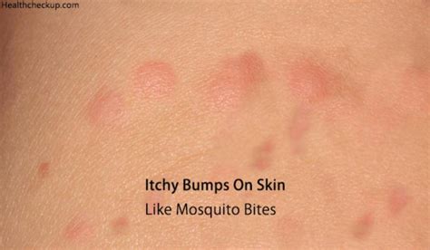 Itchy Bumps on Skin like Mosquito Bites - Causes, Treatment, Prevention