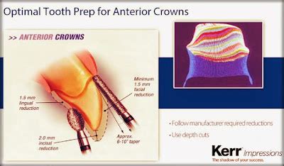 PORCELAIN CROWN: Indirect Dental Procedure - Odonto-Tv