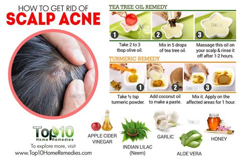 How to Get Rid of Scalp Acne | Top 10 Home Remedies