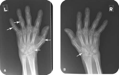 Rheumatoid Arthritis | Radiology Key