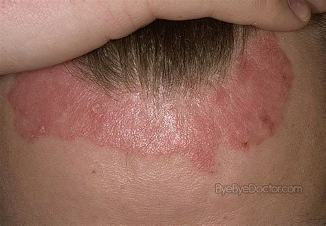 what causes scalp psoriasis - pictures, photos