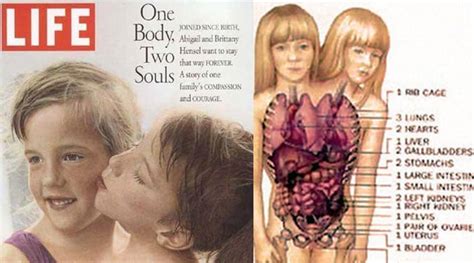 30 Interesting Things About Famous Conjoined Twins Abby And Brittany ...