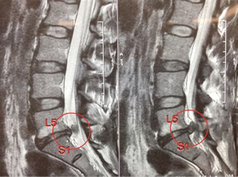 L5 s1 disc replacement surgery