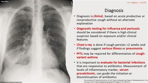 Acute Bronchitis X Ray