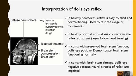 Doll's eye Reflex - YouTube