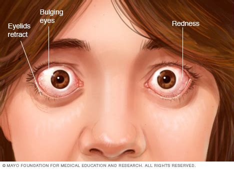 Graves' disease Disease Reference Guide - Drugs.com