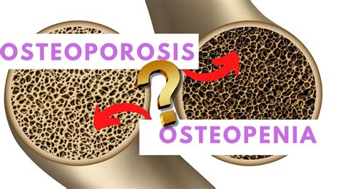 Osteoporosis vs Osteopenia - Explained. - YouTube