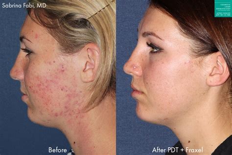 Photodynamic Therapy Acne Treatment | San Diego, CA | CLDerm