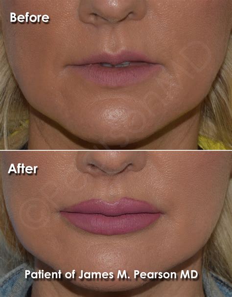 Lip Implant Photos - Before & After - Dr. James Pearson Facial Plastic ...