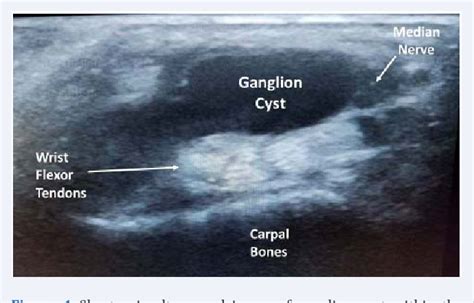 Figure 3 from Point-of-Care Musculoskeletal Ultrasound Evaluation of an ...