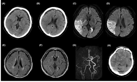 A, B, On admission of an 84-year-old man with paralysis of the left ...