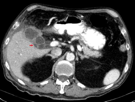 Gallbladder perforation - radiological aspects, types and causes ...