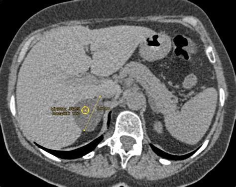 Right Adrenal Adenoma - Adrenal Case Studies - CTisus CT Scanning