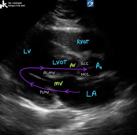 Cardiac Transthoracic Echocardiography (TTE) - Summary And Labeled ...