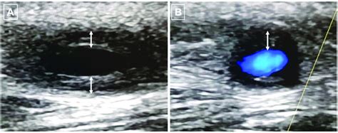 Ultrasound of the temporal artery with halo sign characterised by ...