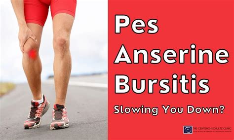 Pes anserine bursitis – Artofit