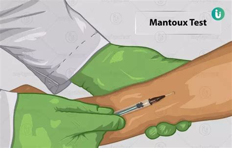 Mantoux Test Principle, Procedure, Interpretation And, 60% OFF