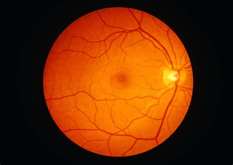 Retinal Detachment: Symptoms, Causes, Diagnosis, and Treatment