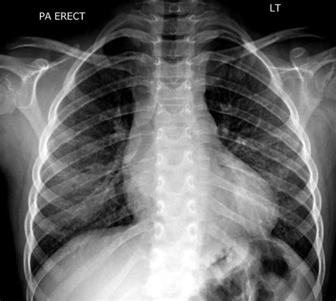 Coarctation of the Aorta in Children