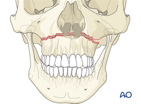 Maxillary Fracture