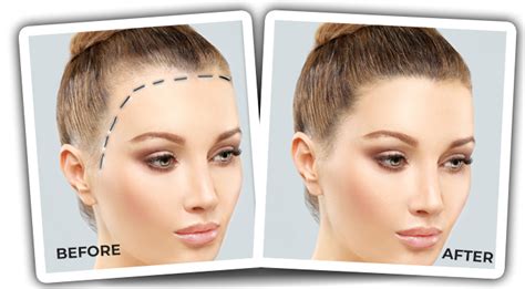 Forehead Reduction with Hair Transplantation in Women - Quartz Hair