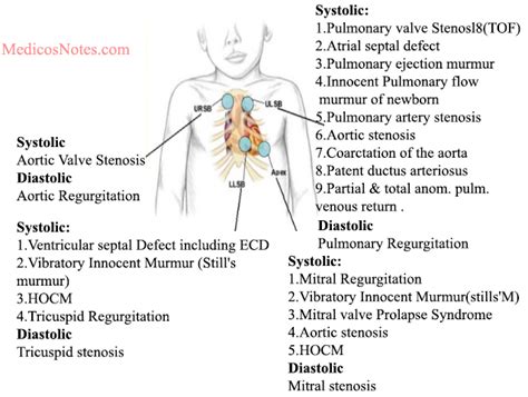 How does aortic coarctation cause radiofemoral delay - cyberlasopa