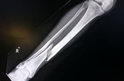 Bone fracture in x-ray. What to know about bone fracture repair | Bone ...