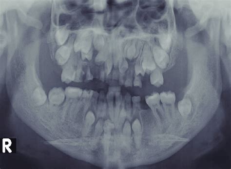 Panoramic X-ray of dentition in Case 1. The deciduous dentition is ...