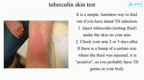 tuberculin skin test (English) - Medical terminology for medical ...