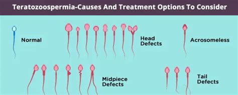 What is Teratozoospermia? Causes, Symptoms & Treatment