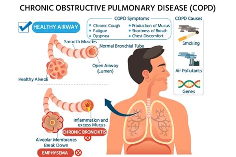 Understanding COPD: Causes, Symptoms, and Treatment - Ask The Nurse Expert