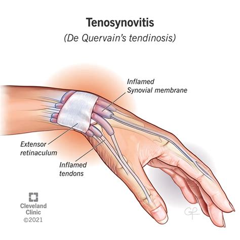 Tenosynovitis: Symptoms, Causes, Types & Treatment