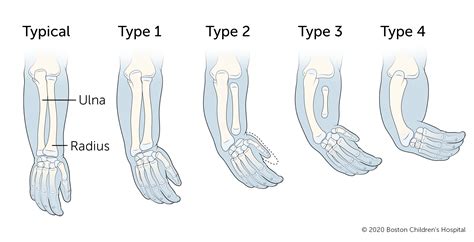 Radial Longitudinal Deficiency (Radial Club Hand) | Boston Children's ...