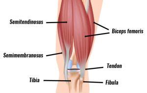 Tendinitis de los isquiotibiales - Síntomas, causas, tratamiento y ...