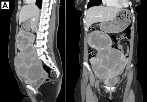 Massively Enlarged Leiomyomatous Uterus