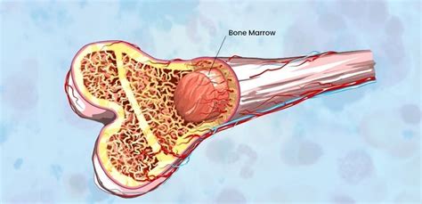 Bone marrow transplant : Why do you need it? - Bansal Hospital