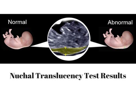 Nuchal Translucency Teat (NT Scan) Procedure To Detect Down Syndrome