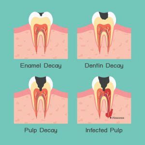 Symptoms of an Abscessed Tooth - Duff Family Dental