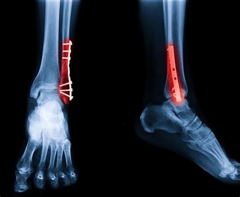 What Should I Expect From Ankle Fracture Surgery and Recovery?: Eugene ...