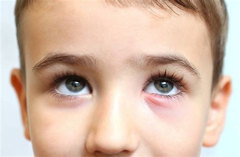 What is a stye? How do you treat a stye? - IRIS