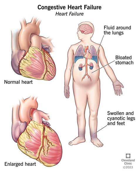 Understanding Congestive Heart Failure - Ask The Nurse Expert