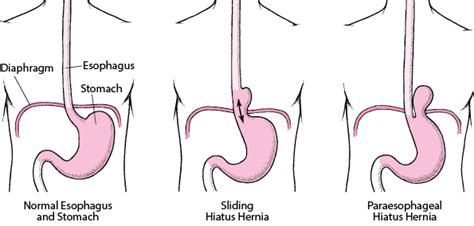 hiatal hernia after having baby - Emerita Brackett