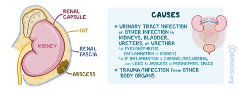 Perinephric Abscess: What Is It, Causes, Diagnosis, Treatment, and More ...