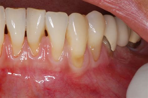 Periodontal - Implant Cases by Dr. Thomas Kang: Free Gingival Grafts