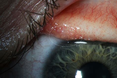 14 worms found crawling in eye of woman with rare infection