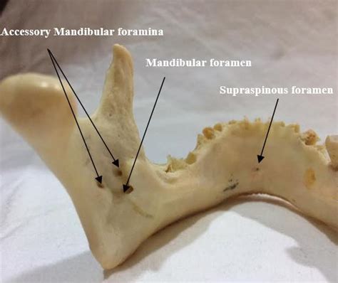 Accessory mandibular, supraspinous and mandibular foramen. | Download ...