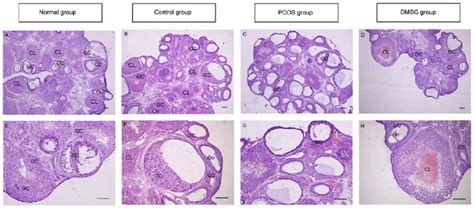 Ovarian Cyst Histology