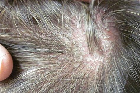 Scalp Psoriasis Symptoms Images - Infoupdate.org